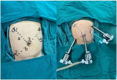 Robot-assisted resection of choledochal cyst in children